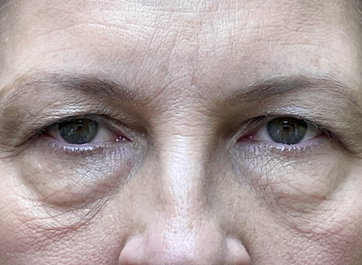 Combination Surgeries (eyelid lift and other)