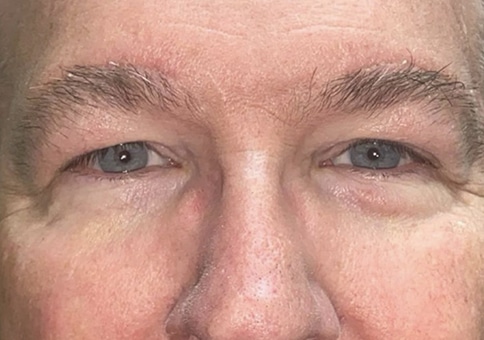 Brow/Forehead Lift