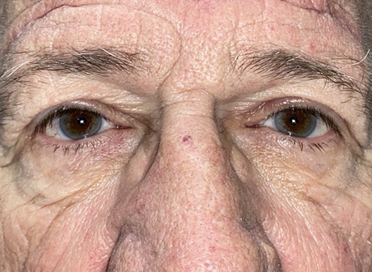 Combination Surgeries (eyelid lift and other)