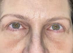 Combination Surgeries (eyelid lift and other)