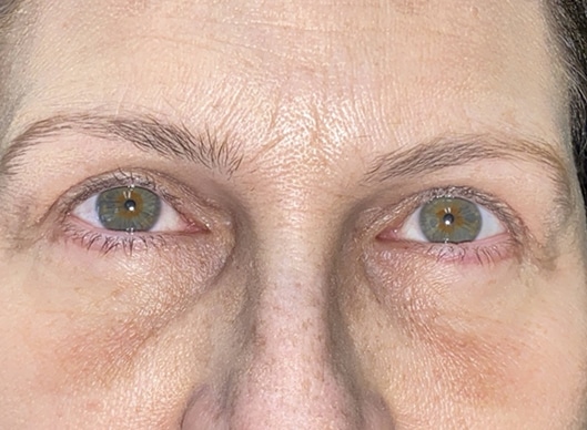 Combination Surgeries (eyelid lift and other)