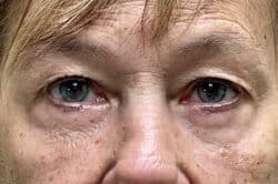 Lower Lid Blepharoplasty (lower eyelid eyelift)