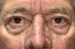 Upper Lid Blepharoplasty (upper eyelid lift)