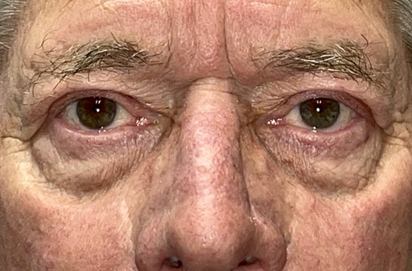 Upper Lid Blepharoplasty (upper eyelid lift)