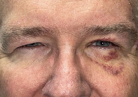 Brow/Forehead Lift