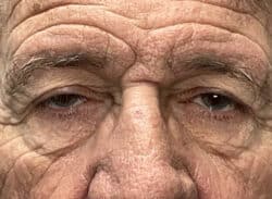 Combination Surgeries (eyelid lift and other)