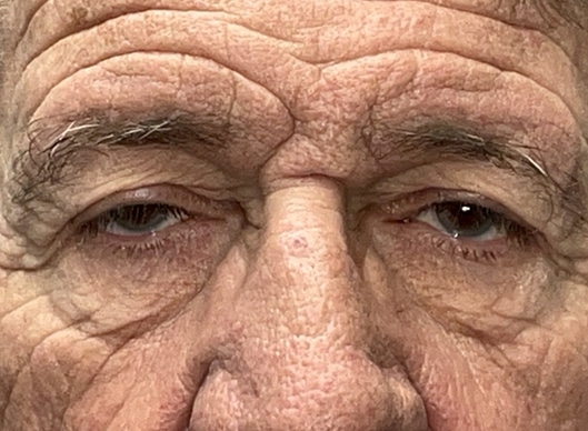 Combination Surgeries (eyelid lift and other)