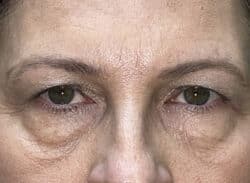 Combination Surgeries (eyelid lift and other)