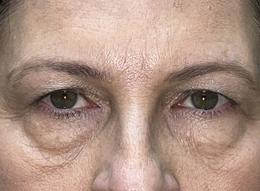Combination Surgeries (eyelid lift and other)