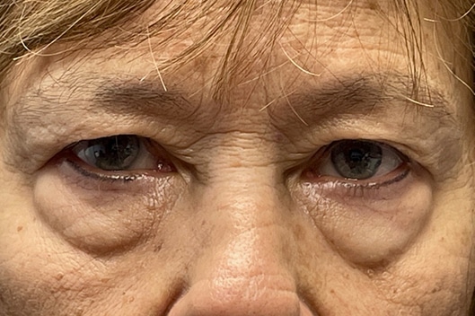 Lower Lid Blepharoplasty (lower eyelid eyelift)