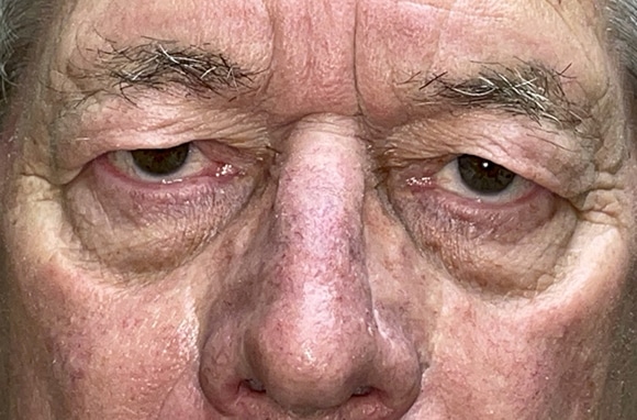 Upper Lid Blepharoplasty (upper eyelid lift)