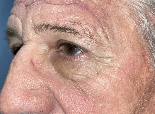 Combination Surgeries (eyelid lift and other)