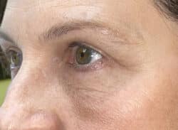 Combination Surgeries (eyelid lift and other)