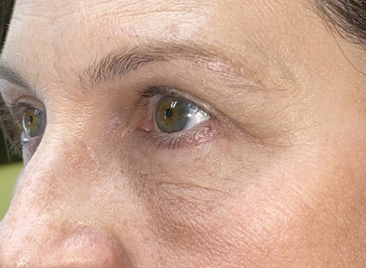 Combination Surgeries (eyelid lift and other)