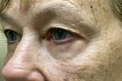 Lower Lid Blepharoplasty (lower eyelid eyelift)