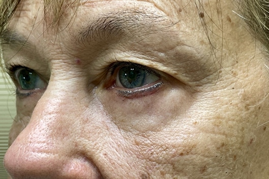 Lower Lid Blepharoplasty (lower eyelid eyelift)
