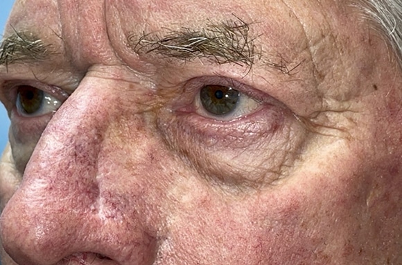 Upper Lid Blepharoplasty (upper eyelid lift)