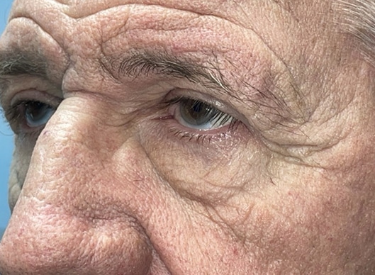Combination Surgeries (eyelid lift and other)