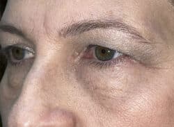Combination Surgeries (eyelid lift and other)