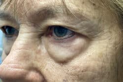 Lower Lid Blepharoplasty (lower eyelid eyelift)