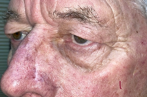 Upper Lid Blepharoplasty (upper eyelid lift)