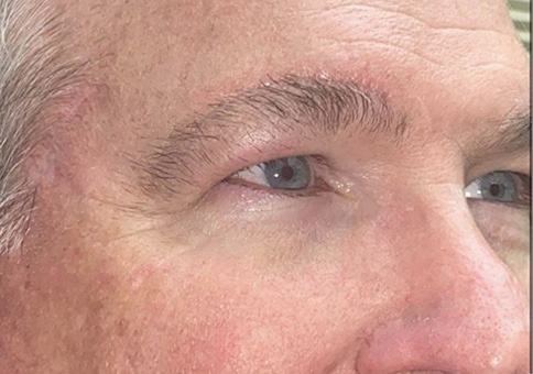 Brow/Forehead Lift