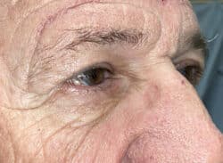 Combination Surgeries (eyelid lift and other)