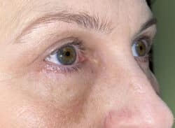 Combination Surgeries (eyelid lift and other)