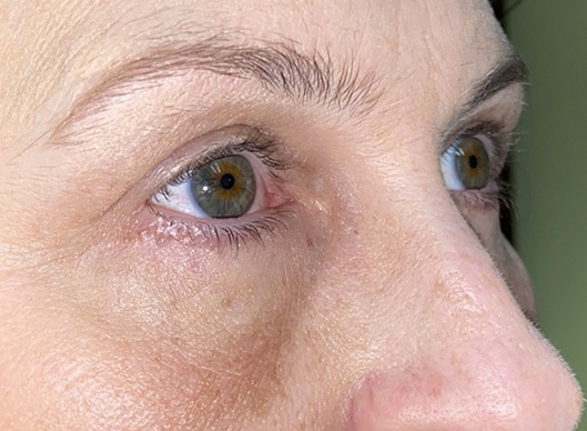 Combination Surgeries (eyelid lift and other)