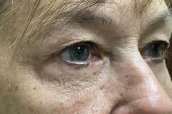 Lower Lid Blepharoplasty (lower eyelid eyelift)