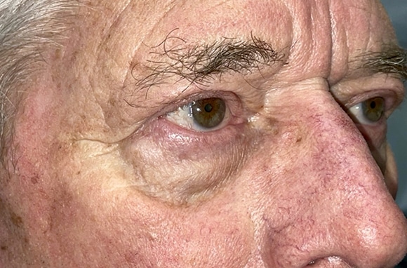 Upper Lid Blepharoplasty (upper eyelid lift)