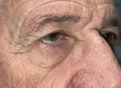 Combination Surgeries (eyelid lift and other)