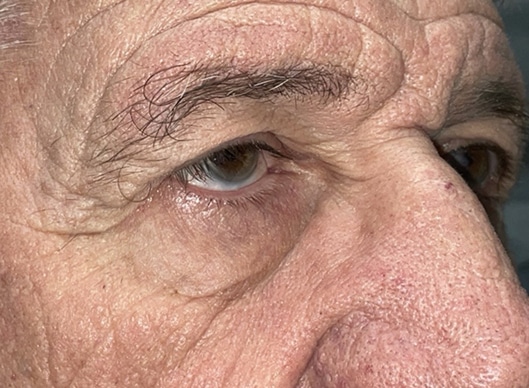 Combination Surgeries (eyelid lift and other)