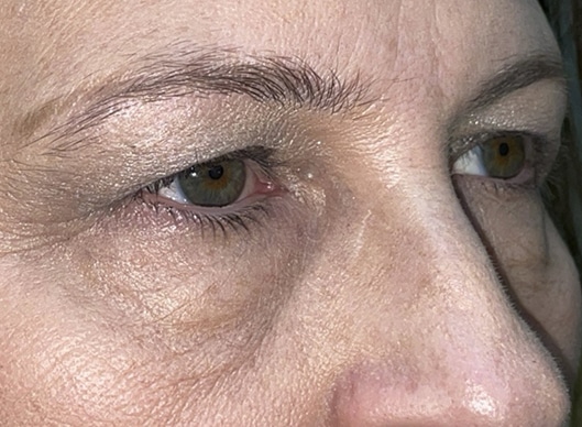 Combination Surgeries (eyelid lift and other)