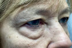 Lower Lid Blepharoplasty (lower eyelid eyelift)