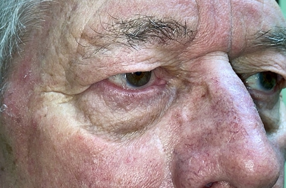 Upper Lid Blepharoplasty (upper eyelid lift)