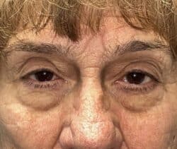 Upper Lid Blepharoplasty (upper eyelid lift)
