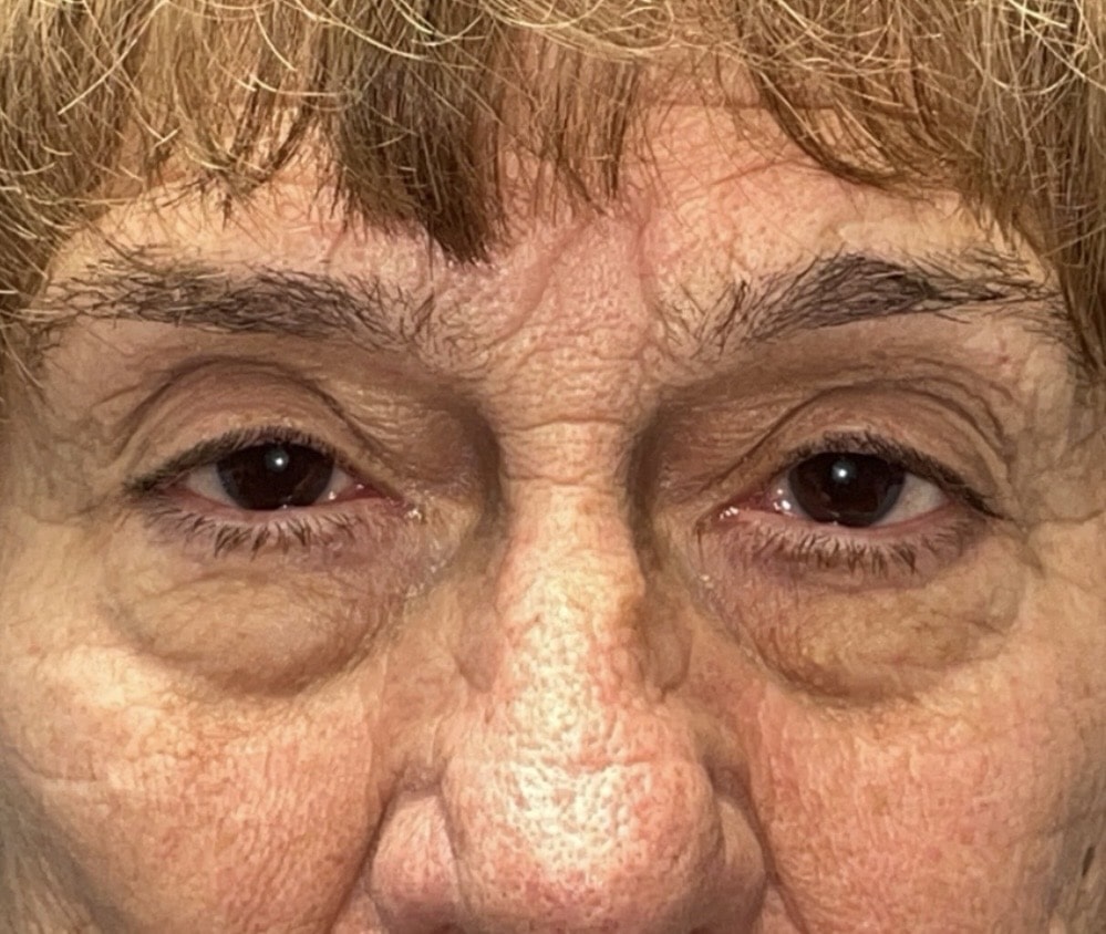 Upper Lid Blepharoplasty (upper eyelid lift)