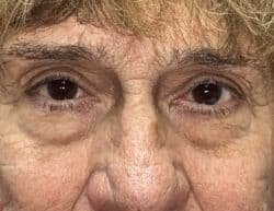 Upper Lid Blepharoplasty (upper eyelid lift)
