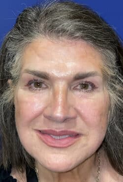 CO2 Laser Resurfacing (wrinkle/line reduction)