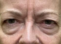 Combination Surgeries (eyelid lift and other)