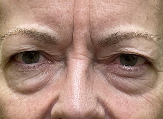 Combination Surgeries (eyelid lift and other)