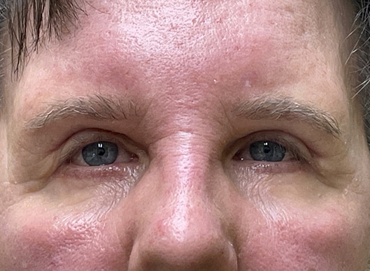 Combination Surgeries (eyelid lift and other)