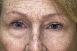 Upper Lid Blepharoplasty (upper eyelid lift)