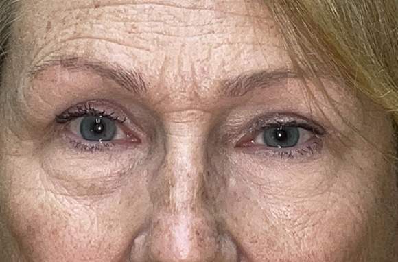Upper Lid Blepharoplasty (upper eyelid lift)