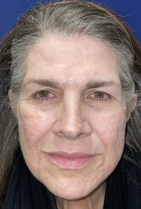 CO2 Laser Resurfacing (wrinkle/line reduction)
