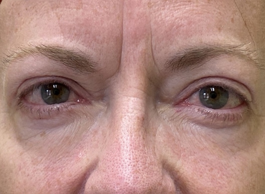 Combination Surgeries (eyelid lift and other)