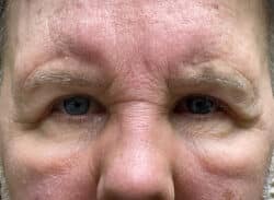 Combination Surgeries (eyelid lift and other)
