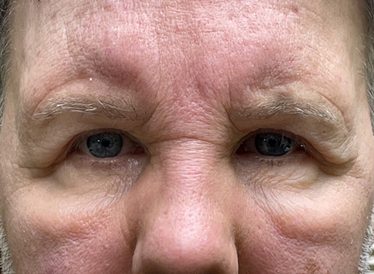 Combination Surgeries (eyelid lift and other)