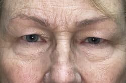 Upper Lid Blepharoplasty (upper eyelid lift)